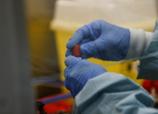 Vaiolo delle scimmie: primo caso confermato a Genova