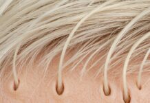 Capelli bianchi: cause, genetica e stili di vita Produzione melanina