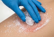 Ustioni: non usare mai il ghiaccio sulla pelle Scottature rimedi