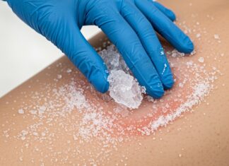 Ustioni: non usare mai il ghiaccio sulla pelle Scottature rimedi