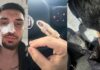 FOTO. Mani spezzate e volto sfregiato: calciatore 28enne massacrato dai banditi a Casoria Raffaele Selva