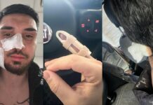 FOTO. Mani spezzate e volto sfregiato: calciatore 28enne massacrato dai banditi a Casoria Raffaele Selva