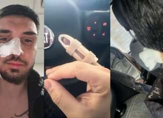 FOTO. Mani spezzate e volto sfregiato: calciatore 28enne massacrato dai banditi a Casoria Raffaele Selva